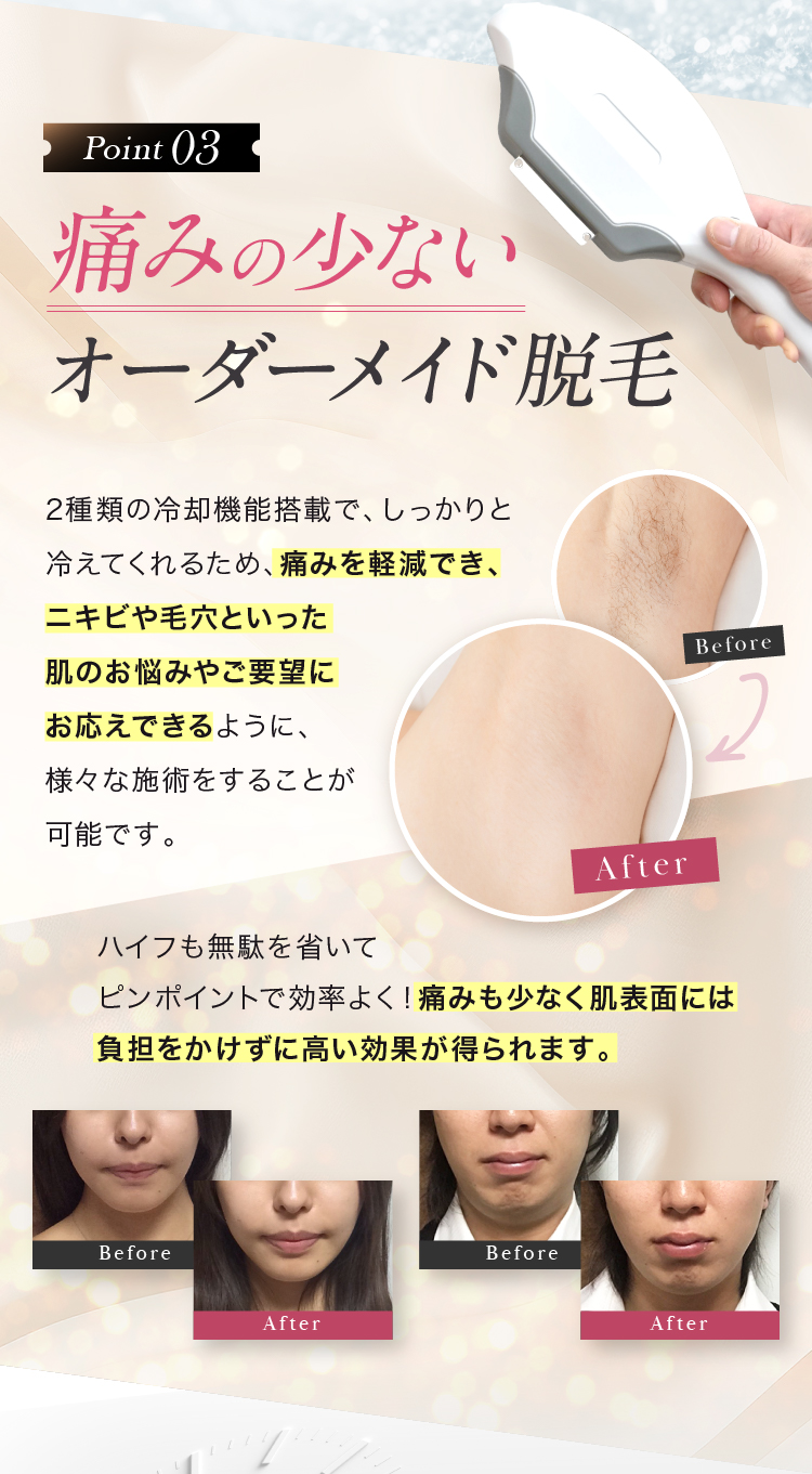 Point03 痛みの少ないオーダーメイド脱毛